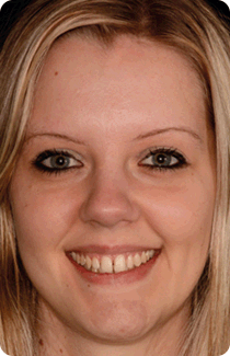 Il sorriso di Alessia con problemi di diastemi, ovvero spazio tra i denti, e la sua soluzione con applicazione di faccette in ceramica.