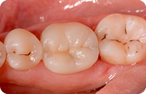 dente pulito da amalgama e carie, chiuso con intarsio