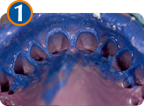 impronta dei denti per la realizzazione delle faccette