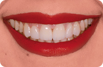 il sorriso di alessia dopo l'aplicazione di faccette in ceramica