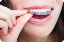 invisalign ortodonzia invisibile