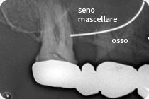 rx osso esiguo e seno mascellare