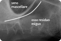 osso ridotto e seno mascellare