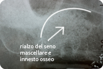 rialzo seno mascellare e innesto osseo