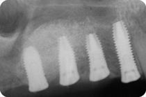 inserimento impianti dopo rigenerazione ossea