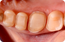 denti ricostruiti