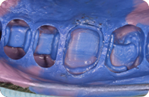 imporonta denti
