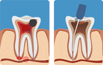 dente sano
