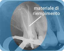 radiografia dente devitalizzato