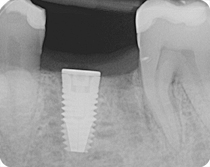 radiografia impianto titanio osseointegrato