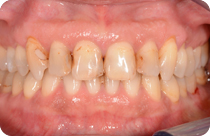 denti da sostituire