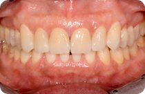 corone in ceramica integrale